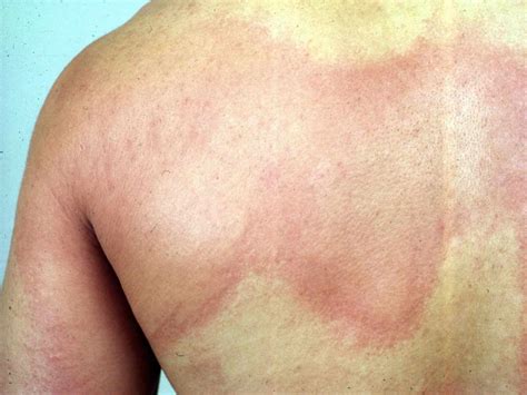 Xolair For The Treatment Of Chronic Hives