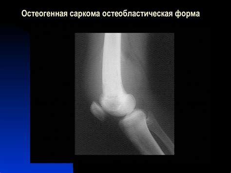 Рентгенодиагностика остеогенной саркомы — презентация