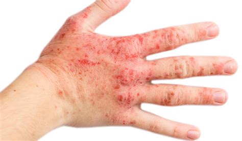 Dermatitis Qu Es Y Como Curarla Unidad M Dica Serrano