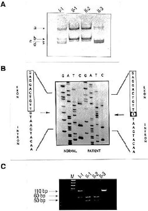 Figure 1 From A Point Mutation In The 5 Splice Site Of The Dystrophin