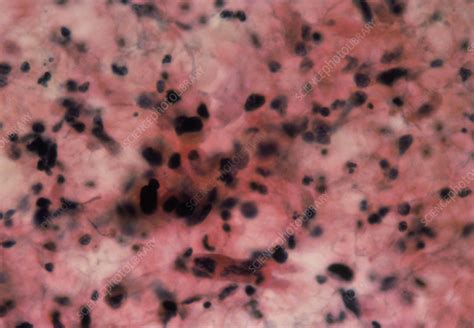 LM Of Cervical Smear Showing Squamous Carcinoma Stock Image M850