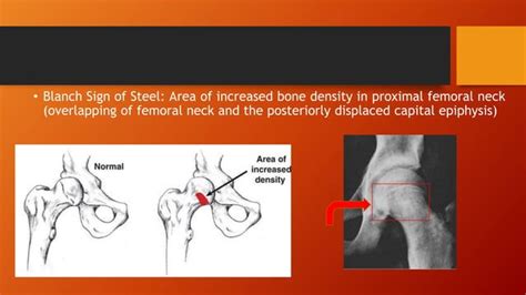 Slipped Capital Femoral Epiphysis Ppt