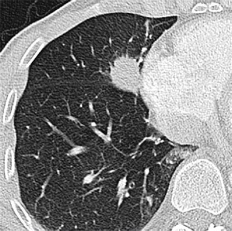 Tumors Of The Lung Radiology Key