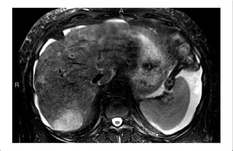 T2 Axial Magnetic Resonance Images Of The Abdomen Showing Enhancing