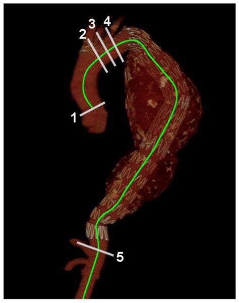 Ijerph Free Full Text Elongation Of The Aorta After Thoracic