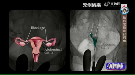 输卵管造影的过程是这样的身体健康公共频道山东网络台齐鲁网