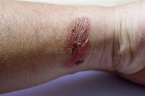 Badly Healed Burn On White Young Man`s Wrist Stock Image Image Of