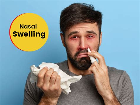 Nose Swelling: Symptoms, Causes And How Can It Be Treated? | OnlyMyHealth