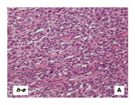 Uterine Tumor Resembling An Ovarian Sex Cord Tumor A Cords Nests