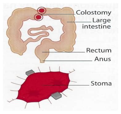 Loop Ileostomy Diagram