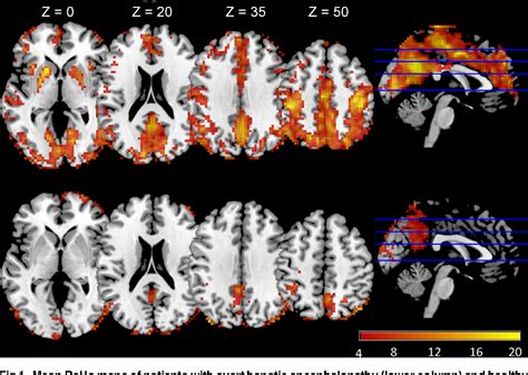 Figure From Resting State Fmri With Reho Analysis As A Non Invasive