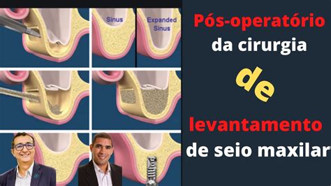 Pós operatório da cirurgia de levantamento de seio maxilar dr