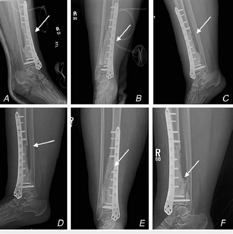 Post Operative X Ray Images A A Lateral View Of The Right Distal Tibia