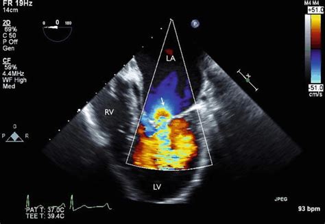 Rheumatic Mitral Valve Disease Radiology Key 55660 Hot Sex Picture