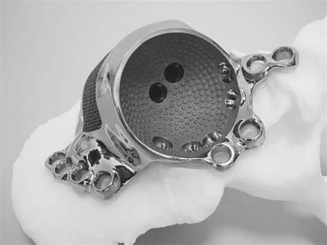 Materialise 3d Printed Hip Implant Gets Patient Back On Her Feet 3d Printing Industry