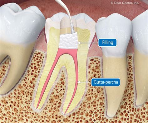 Root Canal Treatment What You Need To Know