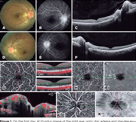 Figure 1 From Optical Coherence Tomography Angiography Findings In