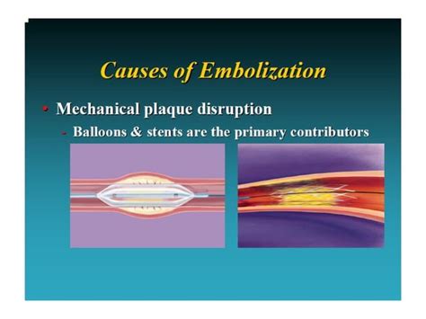 Saphenous Venous Graft Interventions Ppt