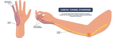 Ulnar Nerve Entrapment At The Elbow Cubital Tunnel Syndrome Bilarasa