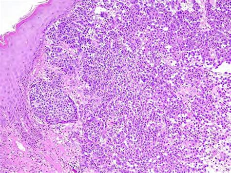 Nodular Melanoma Histology