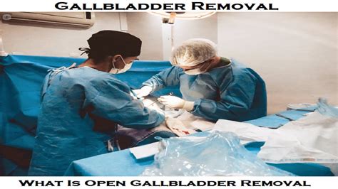 What Is Open Gallbladder Removal Dr Technology Youtube