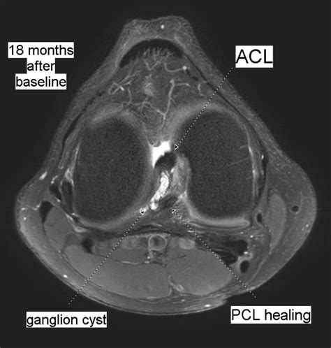 Benoît Rizk On Twitter Posterior Cruciate Ligament Tear After Bike Fall Conservative