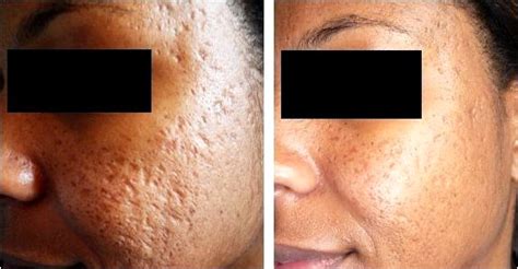 Dermaroller Microneedling For Deep Acne Scarring Proskin Clinics