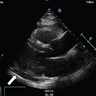 Transthoracic Echocardiogram In The Long Parasternal Axis View A And