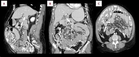 A C Computed Tomography Ct Of The Abdomen And Pelvis With Oral And