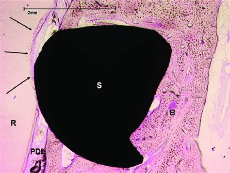 Miniscrew In Contact With Tooth Root Hypercementosis Of The Cementum