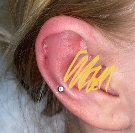 Ear Keloid R Keloids