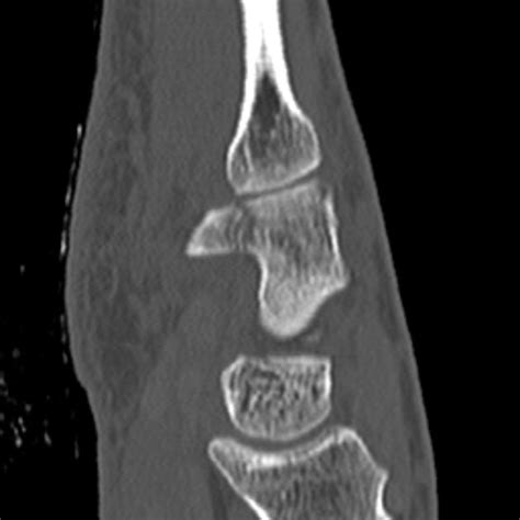 Hook of Hamate Fracture - Hand - Orthobullets