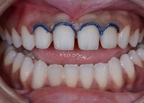 Composite Veneers Pros And Cons