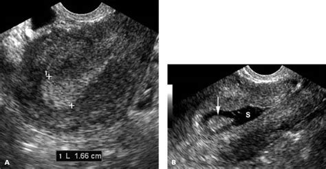 Endometrium Radiology Key