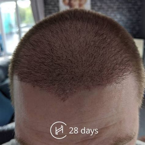 Hair Transplant Recovery Timeline | 0 - 14 Months Photos