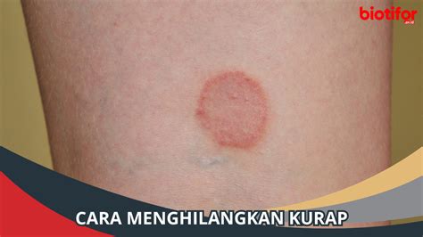 Cara Menghilangkan Kurap Secara Alami Biotifor