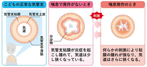 喘息 茨木市の小児科－はら小児科クリニック