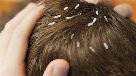 'Super lice' in Wisconsin not responding to typical treatments