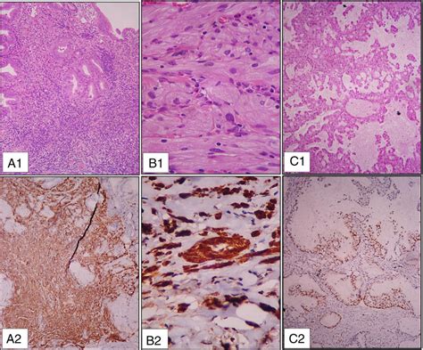 A Histologic Features Of The Gastric Biopsy A1 Gastric Mucosa With Download Scientific