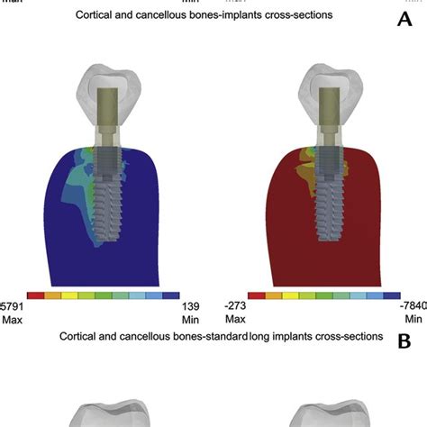 Pdf Effect Of Different Design Of Abutment And Implant On Stress Distribution In 2 Implants