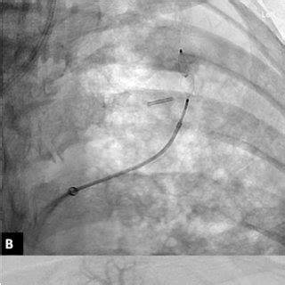 Endovascular Embolisation Of The Left Apical Pulmonary Artery