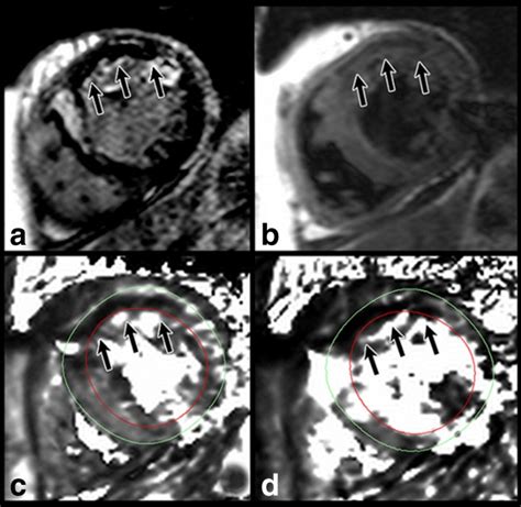 Robust Myocardial T2 And T2 Mapping At 3t Using Image‐based Shimming