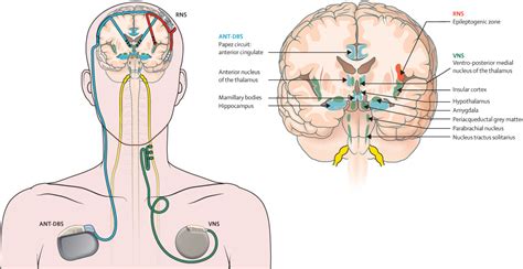 Epilepsy Brain Diagram