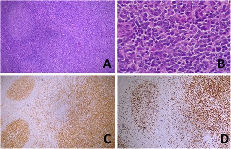 Transformation Of Follicular Lymphoma FL In A Diffuse Large B Cell