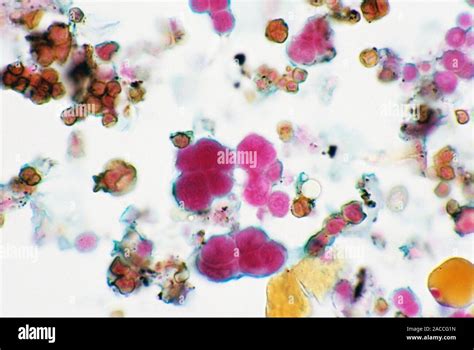 Streptococcus Pneumoniae Light Micrograph Of Clusters Of Streptococcus