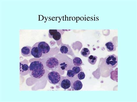 Ppt Myelodysplastic Syndrome And Acute Myeloid Leukaemia Powerpoint