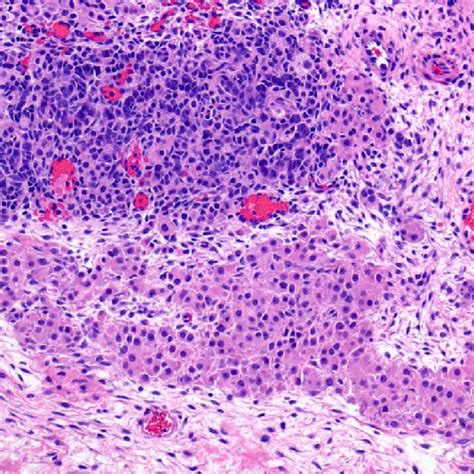 Sertoli Leydig Cell Tumor Component The Top Half Of The Image Depicts