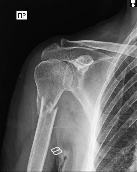 Лечение перелома плеча | Юсуповская больница