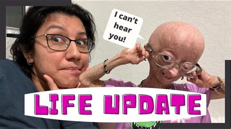 Progeria Adalia Rose Baby