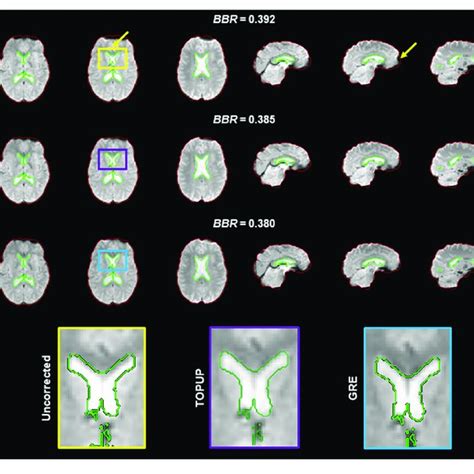 Registration Into The Structural Image Of Top Uncorrected Middle